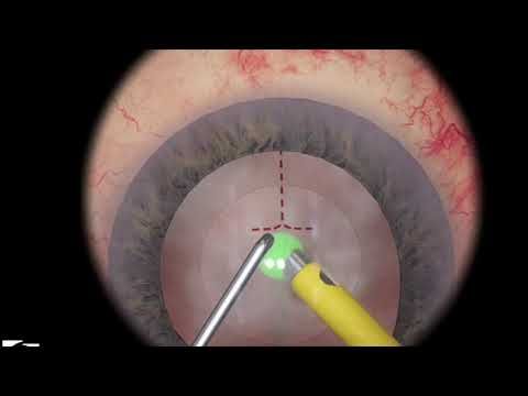 Video guide by Ophthalmology Simulation Explorer: Nucleus™ Level 3 #nucleus