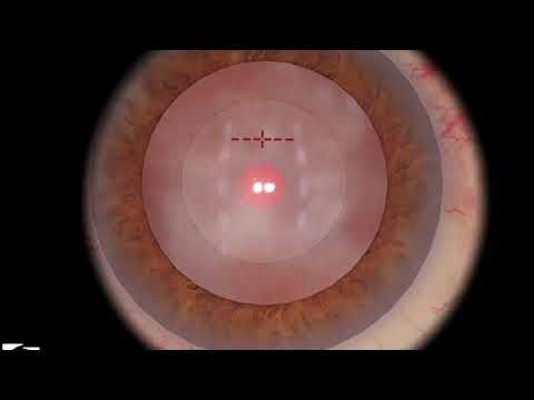 Video guide by Ophthalmology Simulation Explorer: Nucleus™ Level 6 #nucleus