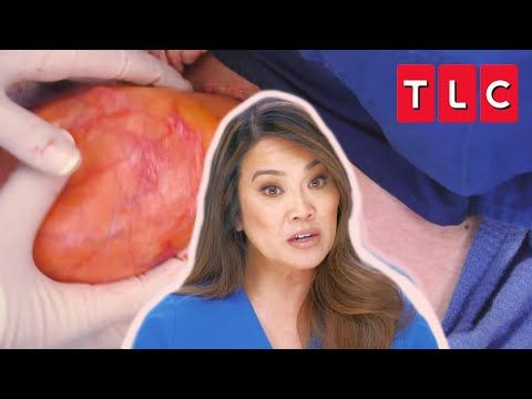 Video guide by TLC: Pimple Popper Part 1 #pimplepopper